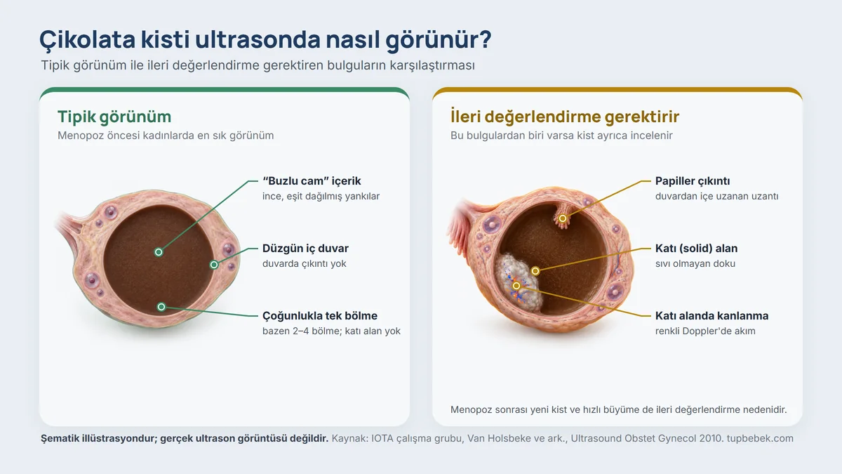 Şematik illüstrasyon: yumurtalık kesitinde solda buzlu cam içerikli, düzgün duvarlı tipik çikolata kisti; sağda papiller çıkıntı, katı alan ve katı alanda kanlanma gösteren, ileri değerlendirme gerektiren kist
